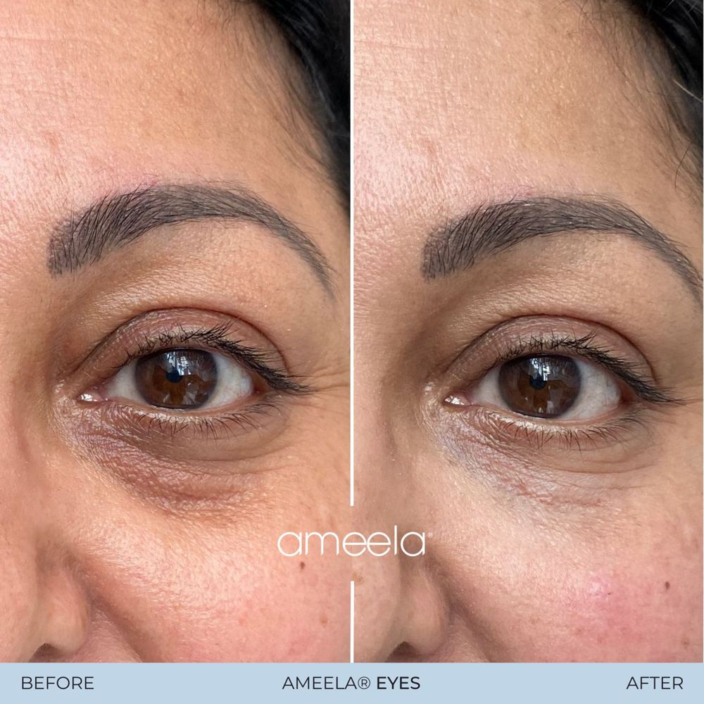 Under-eye rejuvenation: before and after