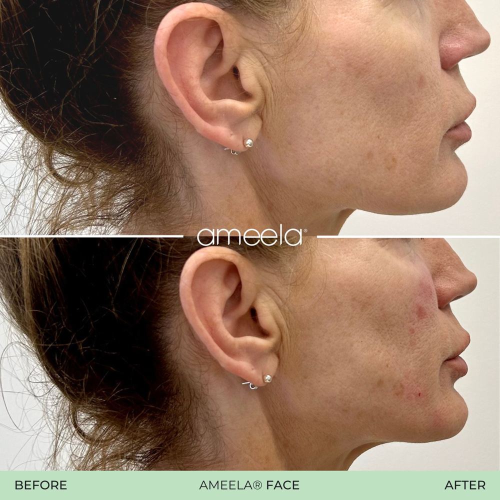 Skin rejuvenation: before and after